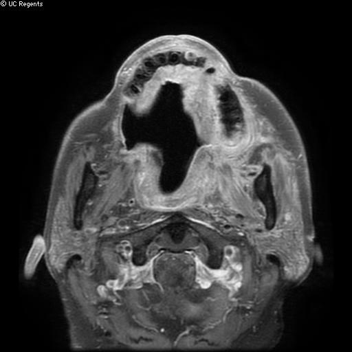 Bisphosphonate-related osteonecrosis of the maxilla (Radiopaedia 51367-57101 Axial T1 C+ fat sat 17).jpg