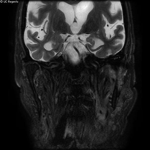 File:Bisphosphonate-related osteonecrosis of the maxilla (Radiopaedia 51367-57101 Coronal T2 fat sat 5).jpg
