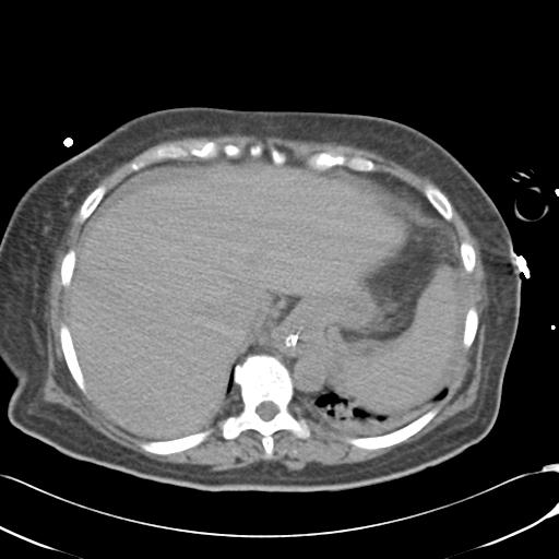 Bladder rupture post renal biopsy (Radiopaedia 30863-31572 Axial non-contrast 13).jpg