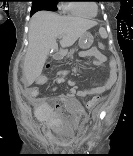Bladder rupture post renal biopsy (Radiopaedia 30863-31572 Coronal non-contrast 23).jpg