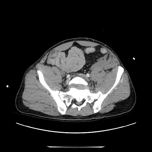 Blunt abdominal trauma with solid organ and musculoskelatal injury with active extravasation (Radiopaedia 68364-77895 A 118).jpg