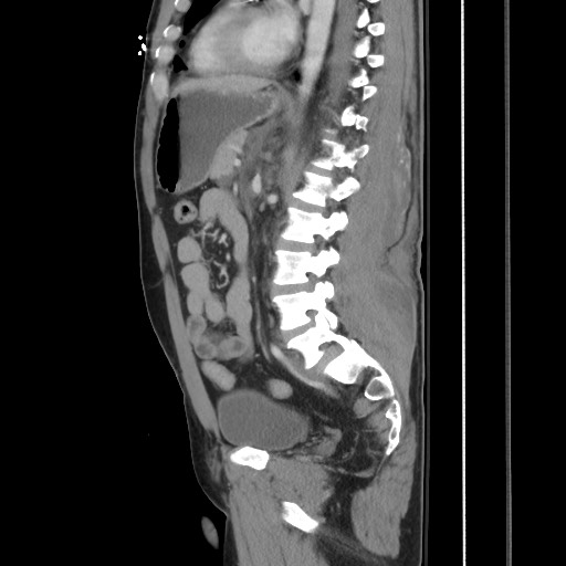 Blunt abdominal trauma with solid organ and musculoskelatal injury with active extravasation (Radiopaedia 68364-77895 C 86).jpg