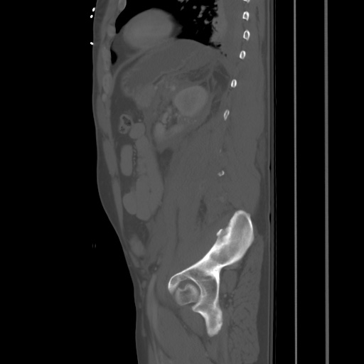 Blunt abdominal trauma with solid organ and musculoskelatal injury with active extravasation (Radiopaedia 68364-77895 Sagittal bone window 76).jpg