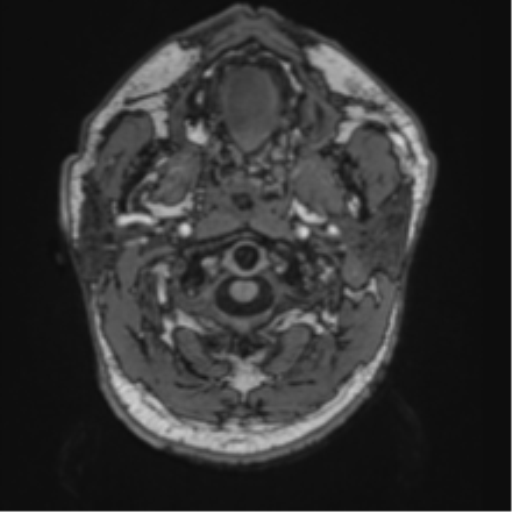 File:Blunt cerebrovascular injury (Radiopaedia 53682-59745 Axial T1 1).png