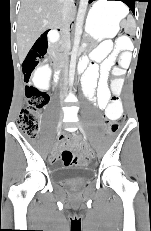 Blunt injury to the small bowel (Radiopaedia 74953-85987 B 50).jpg