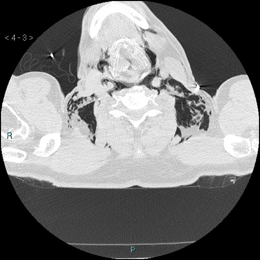 Boerhaave syndrome (Radiopaedia 27683-27897 lung window 1).jpg