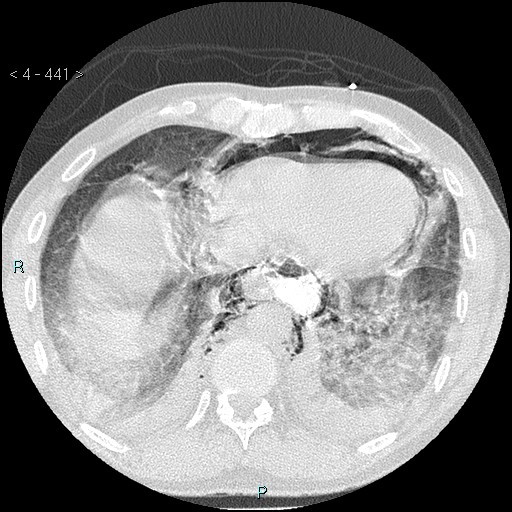 Boerhaave syndrome (Radiopaedia 27683-27897 lung window 74).jpg