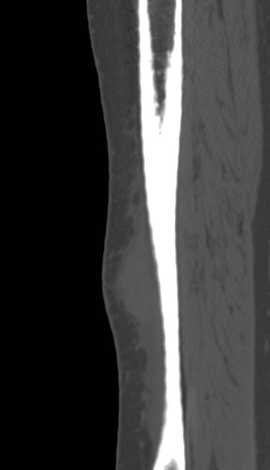 Bone metastasis - tibia (Radiopaedia 57665-64609 Sagittal bone window 45).jpg