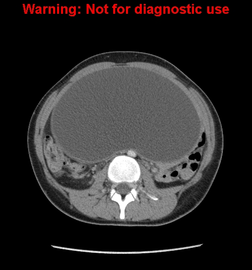 Borderline mucinous cystadenoma of ovary (Radiopaedia 25586-25767 A 26).jpg