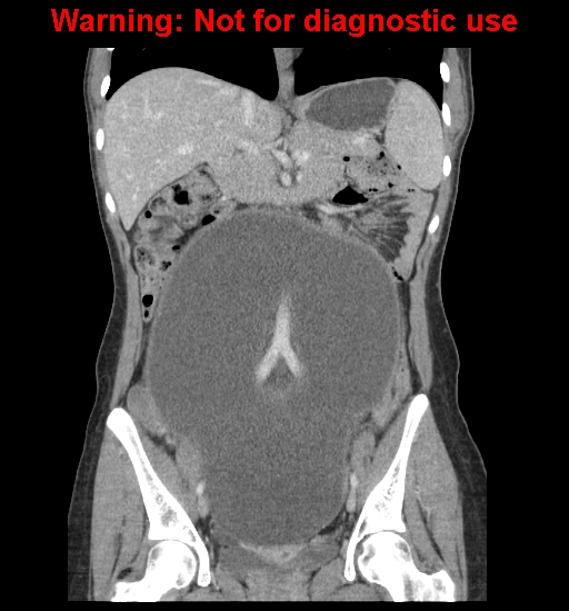 Borderline mucinous cystadenoma of ovary (Radiopaedia 25586-25767 B 34).jpg
