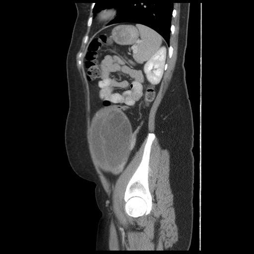 File:Borderline mucinous tumor (ovary) (Radiopaedia 78228-90808 B 50).jpg