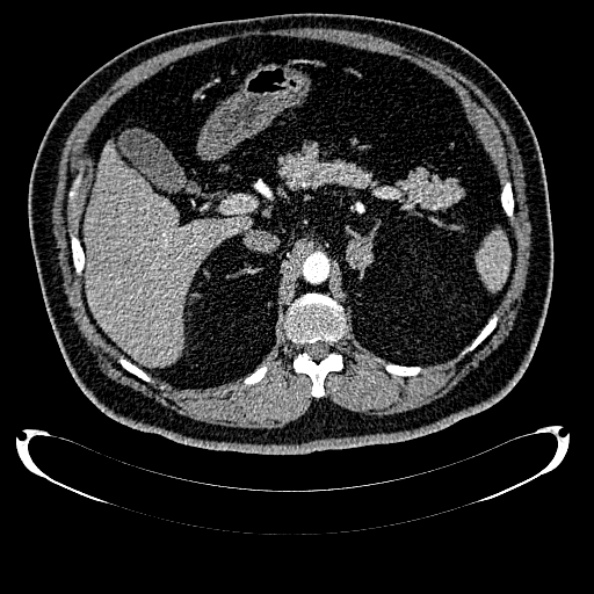 File:Bosniak renal cyst - type IV (Radiopaedia 24244-24518 B 94).jpg