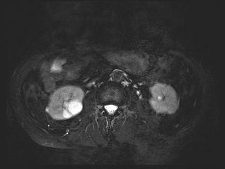 File:Bouveret syndrome (Radiopaedia 61017-68856 Axial MRCP 41).jpg