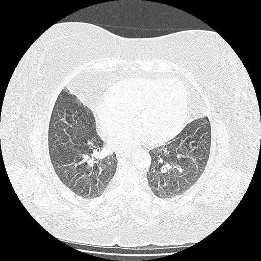 Bovine aortic arch - right internal mammary vein drains into the superior vena cava (Radiopaedia 63296-71875 Axial lung window 104).jpg