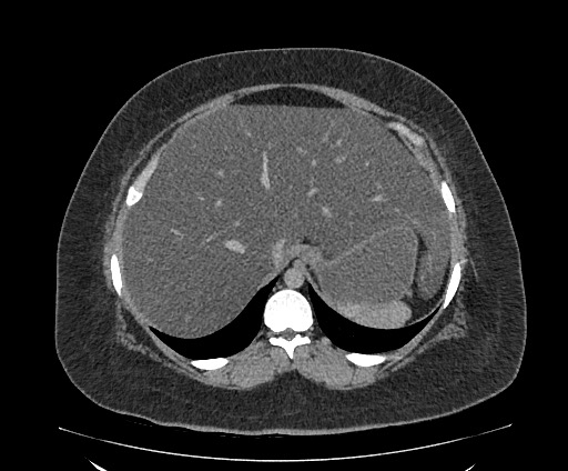 Bowel and splenic infarcts in acute lymphocytic leukemia (Radiopaedia 61055-68913 A 31).jpg