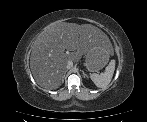 Bowel and splenic infarcts in acute lymphocytic leukemia (Radiopaedia 61055-68913 A 43).jpg