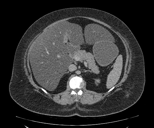 File:Bowel and splenic infarcts in acute lymphocytic leukemia (Radiopaedia 61055-68913 A 50).jpg