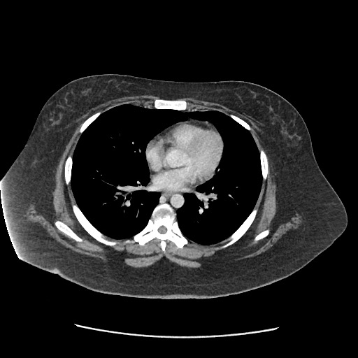 Bowel and splenic infarcts in acute lymphocytic leukemia (Radiopaedia 61055-68915 A 6).jpg