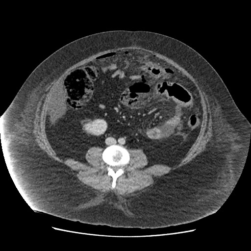 Bowel and splenic infarcts in acute lymphocytic leukemia (Radiopaedia 61055-68915 A 80).jpg