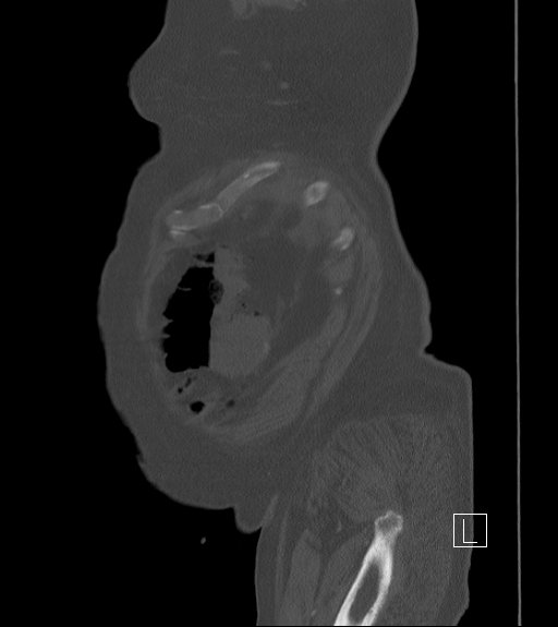 Bowel ischemia secondary to SMA occlusion with extensive portomesenteric venous gas (Radiopaedia 54656-60871 Sagittal bone window 107).jpg
