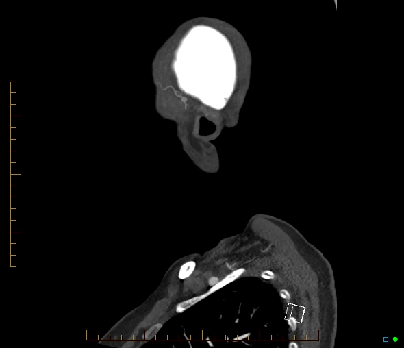 Brachiocephalic trunk stenosis (Radiopaedia 87242-103519 C 1).jpg