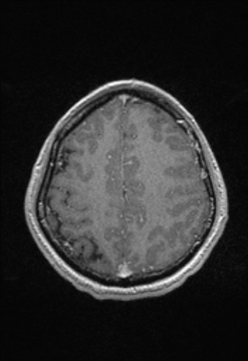 Brain abscess with ventriculitis (Radiopaedia 85703-101495 Axial T1 C+ 134).jpg