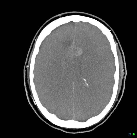 Brain death on MRI and CT angiography (Radiopaedia 42560-45841 B 21).jpg