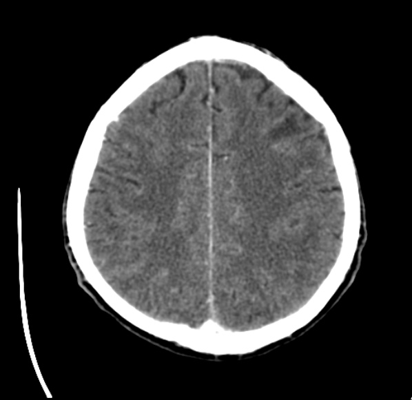 File:Brain metastases from lung cancer (Radiopaedia 24480-24781 Axial C+ delayed 45).jpg
