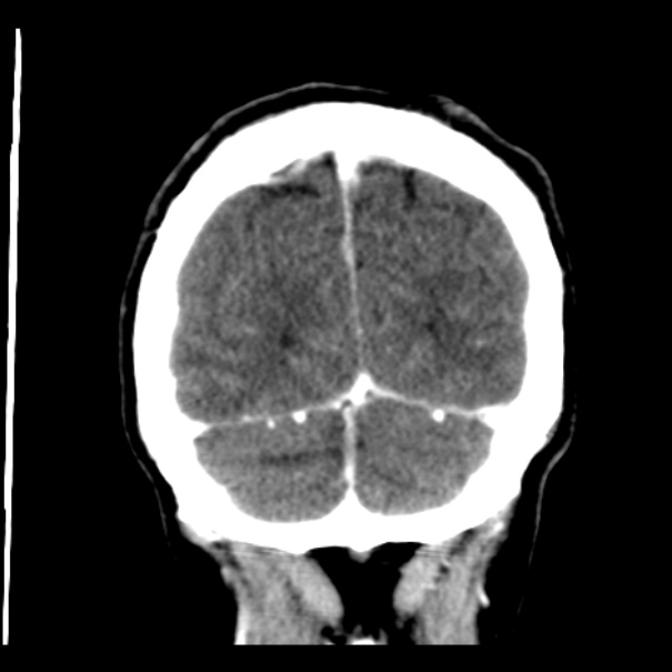 Brain metastases from lung cancer (Radiopaedia 24480-24781 Coronal C+ delayed 54).jpg
