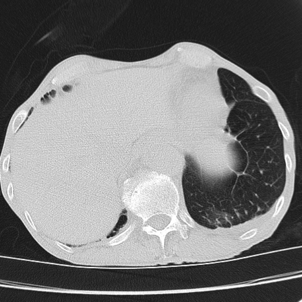 Brain metastases from lung cancer (Radiopaedia 27849-28093 Axial lung window 57).jpg