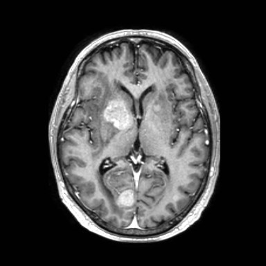 Brain metastases from lung cancer (Radiopaedia 83839-99028 Axial T1 C+ 32).jpg