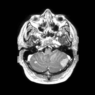 File:Brain metastases from lung cancer (Radiopaedia 83839-99028 Axial T1 C+ 9).jpg
