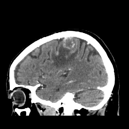 Brain metastasis (Radiopaedia 42617-45760 D 42).jpg