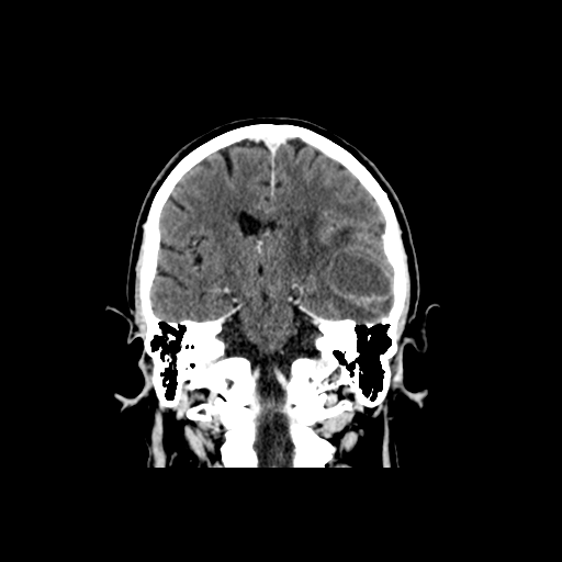 Brain metastasis (large cystic mass) (Radiopaedia 47497-52106 Axial C+ 1).png
