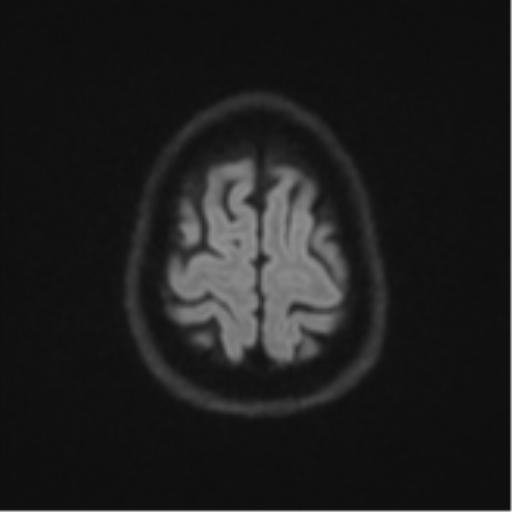 Brain metastasis (large cystic mass) (Radiopaedia 47497-52107 Axial DWI 52).png