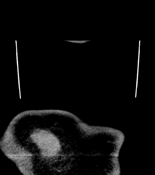 File:Branchial cleft cyst (Radiopaedia 31167-31875 Coronal C+ delayed 71).jpg