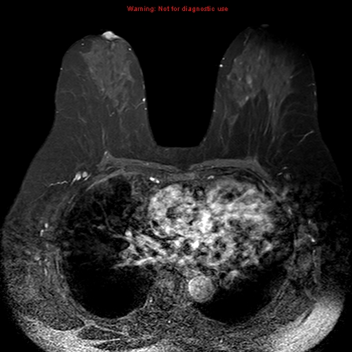 File:Breast carcinoma (multicentric multifocal in mammary Paget disease) (Radiopaedia 50966-56512 Axial T1 C+ fat sat 8).jpg