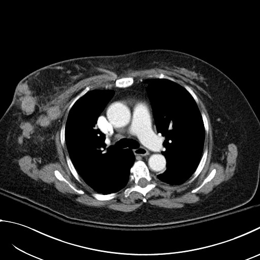 File:Breast carcinoma with pathological hip fracture (Radiopaedia 60314-67974 A 22).jpg