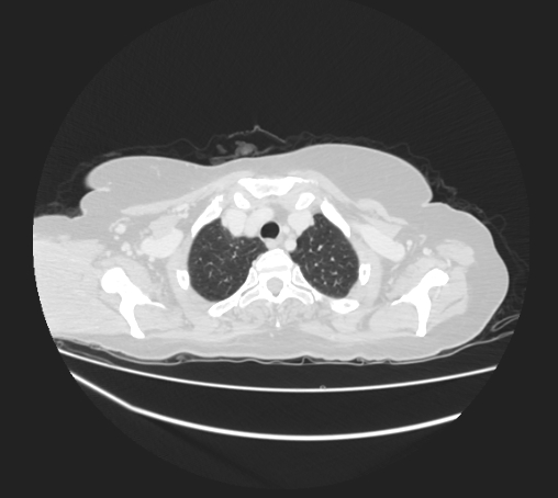 Breast metastases from facial malignant melanoma (Radiopaedia 60316-67975 Axial lung window 10).jpg