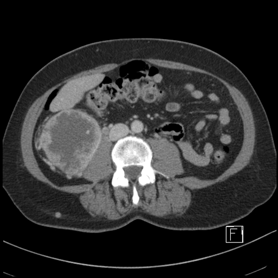 File:Breast metastases from renal cell cancer (Radiopaedia 79220-92225 C 57).jpg