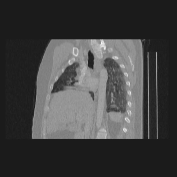 Bronchial atresia (Radiopaedia 60685-68439 Sagittal lung window 42).jpg