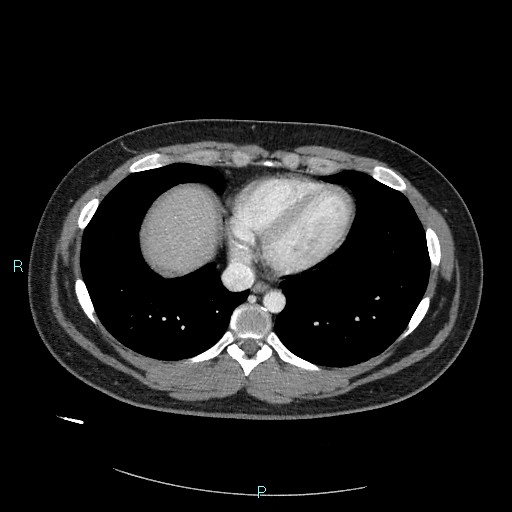 Bronchial carcinoid tumor (Radiopaedia 78272-90875 A 71).jpg