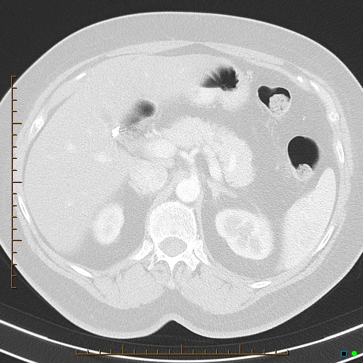 Bronchial diverticula (Radiopaedia 79512-92675 Axial lung window 54).jpg