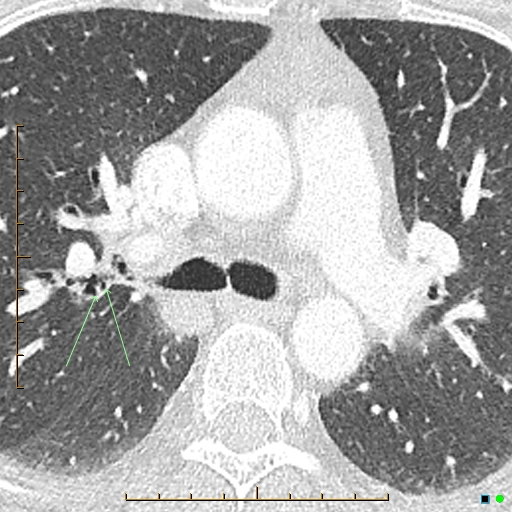 File:Bronchial diverticula (Radiopaedia 79512-92677 Axial lung window 5).jpg