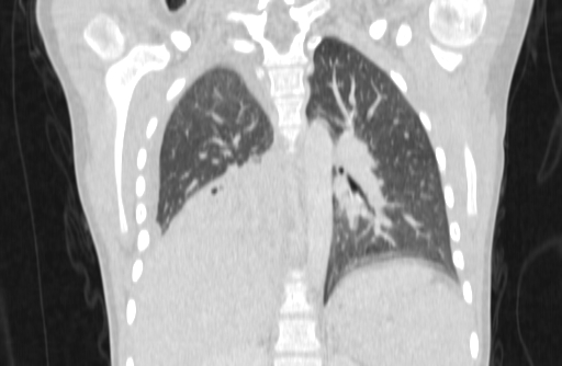 Bronchial mucoepidermoid carcinoma (Radiopaedia 57023-63895 Coronal lung window 46).jpg