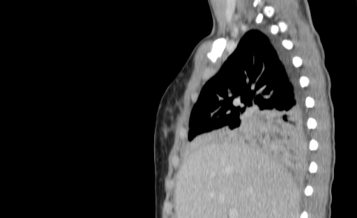 Bronchial mucoepidermoid carcinoma (Radiopaedia 57023-63895 Sagittal 61).jpg