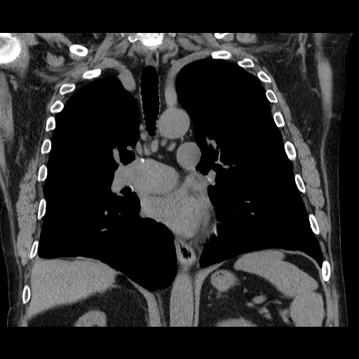 Bronchial stenosis - lung transplant (Radiopaedia 73133-83848 Coronal non-contrast 37).jpg