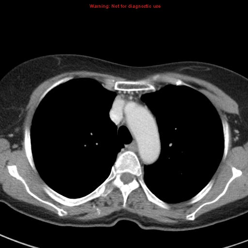 File:Bronchoalveolar carcinoma (BAC) (Radiopaedia 13436-13392 B 16).jpg