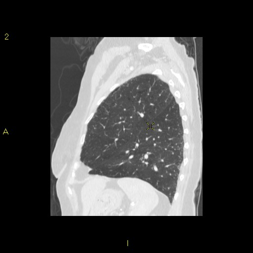 File:Bronchogenic carcinoma as an incidental finding (Radiopaedia 16453-16130 Sagittal lung window 14).jpg