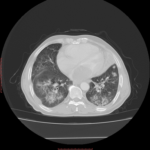 File:Bronchogenic carcinoma with left atrial large deposit - T4N3M1a (Radiopaedia 42316-45428 Axial lung window 20).jpg